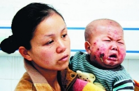 14个月大男婴怪病缠身脸部糜烂 父母辛酸求助
