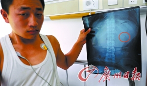 小周展示自己胃部鱼钩的X光片。记者 邵权达 摄