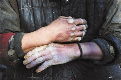 12月3日，通州台湖镇徐庄村一豆腐黑作坊内的一名智障工，双手变形浮肿，他称常被作坊老板殴打。