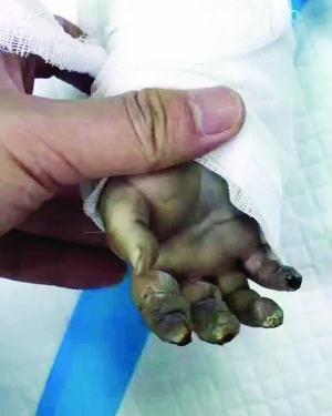 婴儿手指严重烧伤 医院供图
