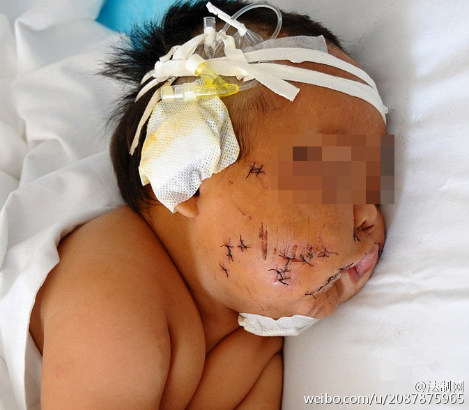 2016年10月14日报道，这名八个月的男婴被送到医院医治时，检查出几十个伤口，缝了一百多针，经过详细检查，男婴身上一共九十多处伤口，遍布全身，主要集中在脸部，几乎都是被锋利的器具插伤。