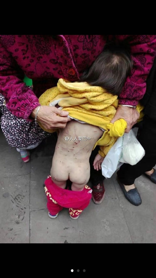 女童后背出现多处伤痕。 来源：@人人爱巴中