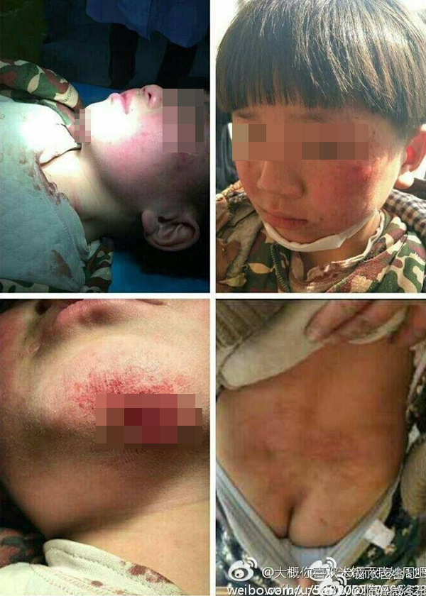就医照片显示，小男孩脸部、颈部、背部多处淤伤，下巴处出现一条深长的血口。