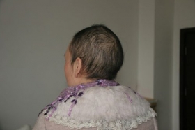 河南女教师发炎被误诊为癌症 化疗半月头发全掉