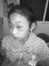 11岁女孩被刀割针扎满身伤 警方刑拘养父母