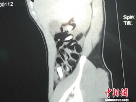 男子腹中藏毒73包 CT扫描一肚子“蚕蛹”