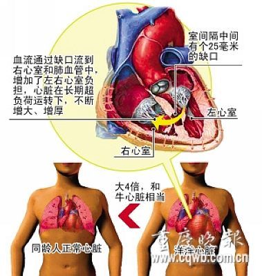 男孩天生心脏大如牛心 心脏跳动让床震动(图)