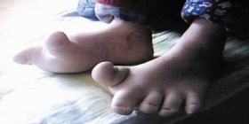 女童年仅4岁穿40码鞋 因脚大遭幼儿园拒收
